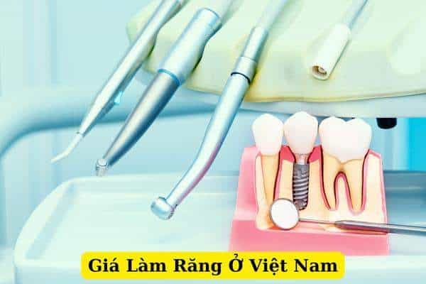 Tìm hiểu giá làm răng ở Việt Nam các dịch vụ