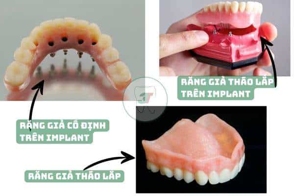 các loại răng giả nguyên hàm