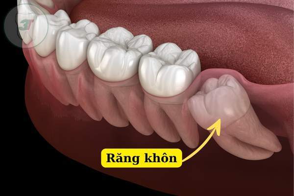 quá trình móc răng khôn có thể gây đau