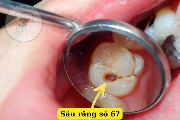Sâu Răng Số 6: Nguyên nhân, dấu hiệu và điều trị