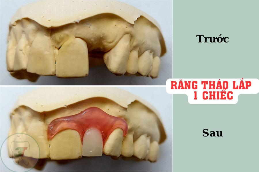 trước và sau làm răng tháo lắp 1 chiếc