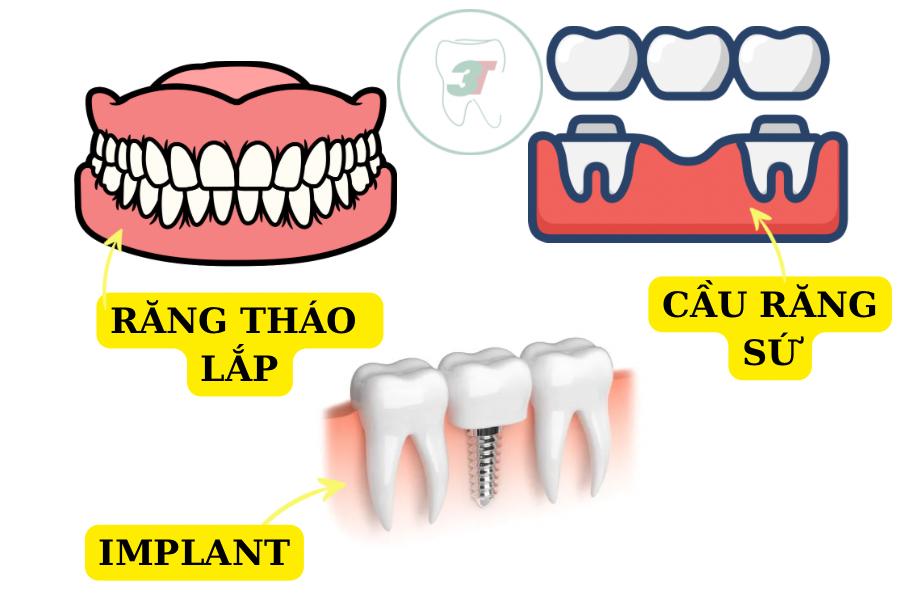 Các phương pháp trồng răng hàm