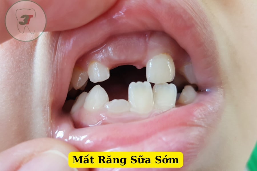 Mất răng sữa sớm khiến răng không đều khi thay răng