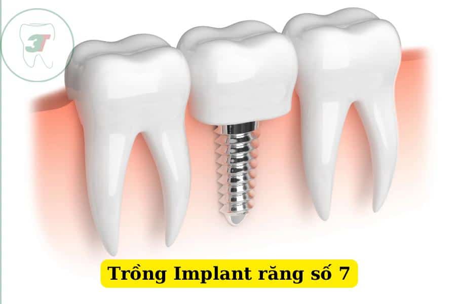 Trồng implant răng nhai số 7