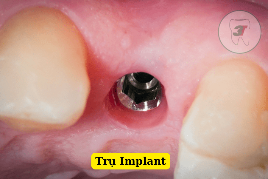 Trụ implant