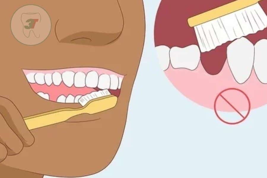 cách vệ sinh răng sau khi nhổ răng