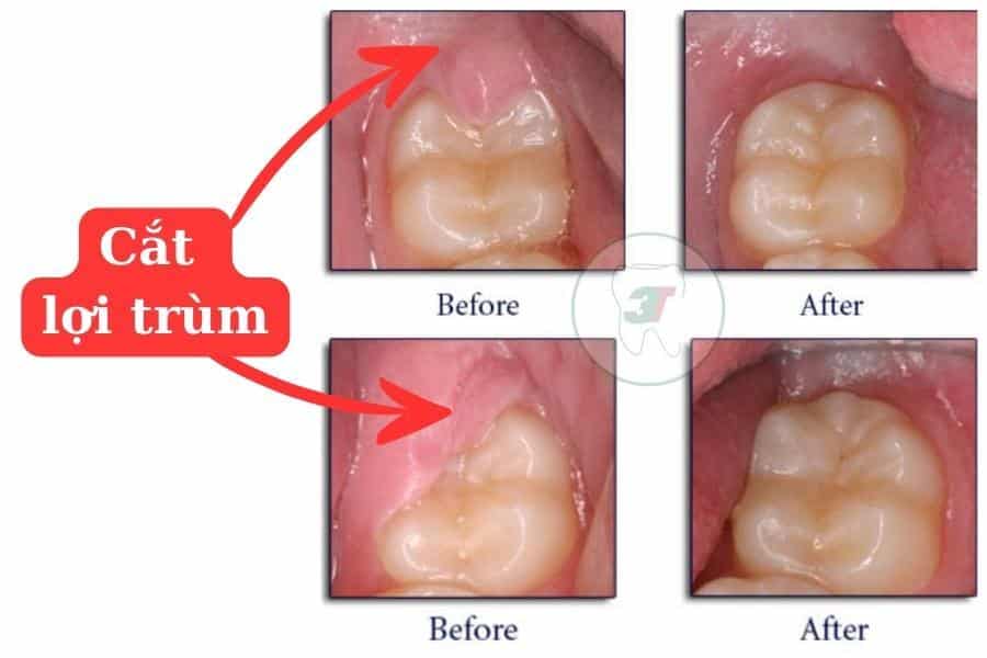 Cắt lợi trùm răng khôn trước và sau