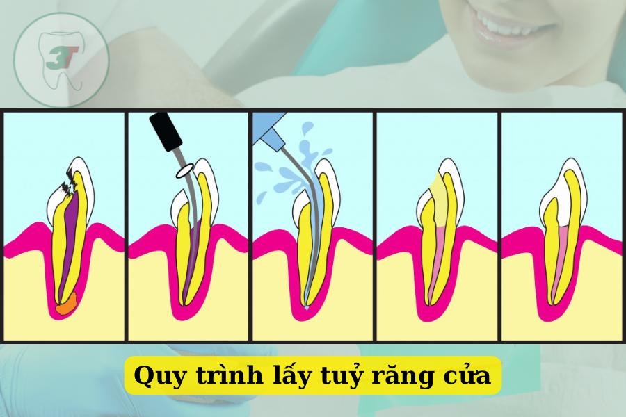 quy trình lấy tuỷ răng cửa