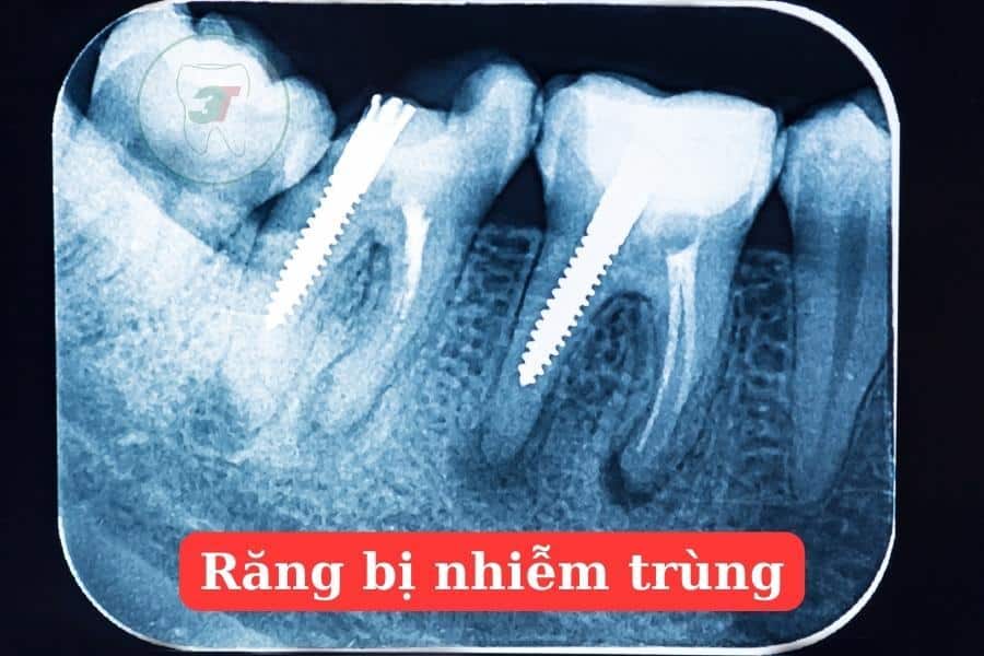 răng bị nhiễm trùng sau khi lấy tủy răng