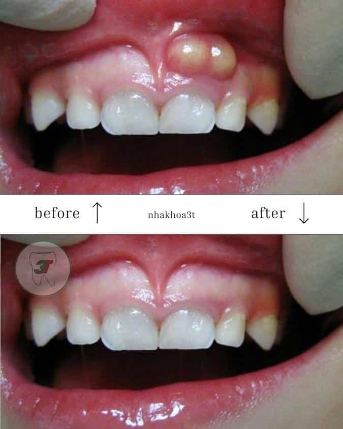 Trước sau khi điều trị áp xe răng