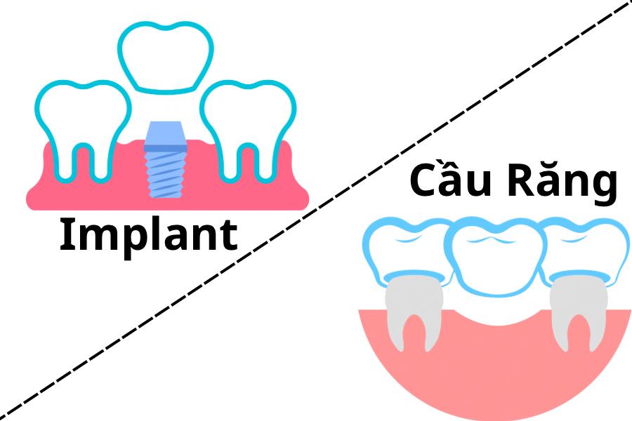 Cấy ghép implant hay cầu răng sứ