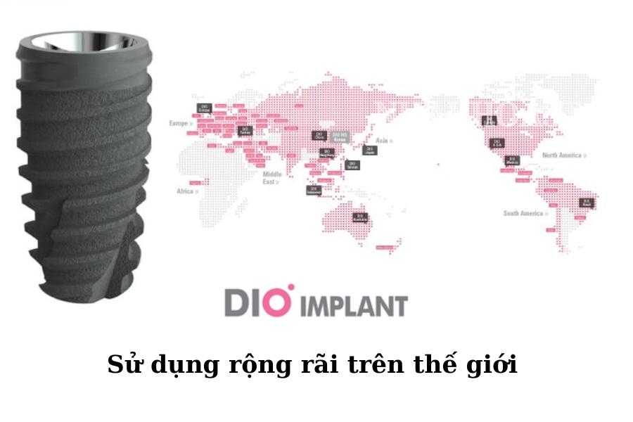 Implant dio sử dụng rộng rãi trên thế giới
