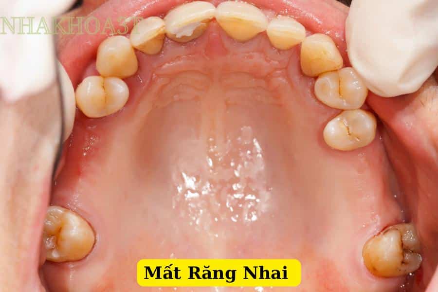 mất răng, mất chân răng