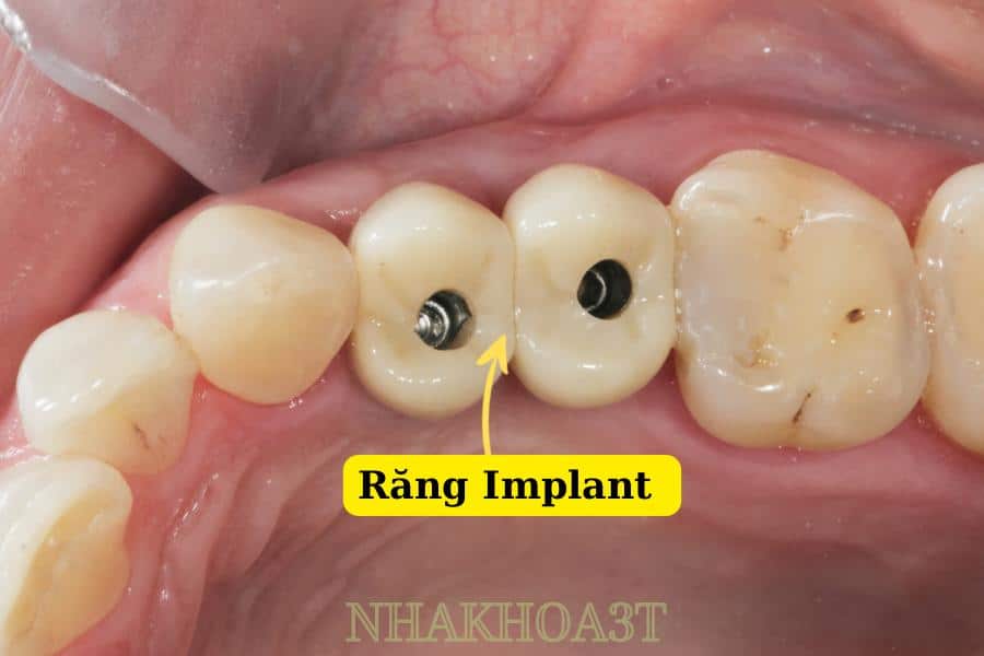 Rang Implant