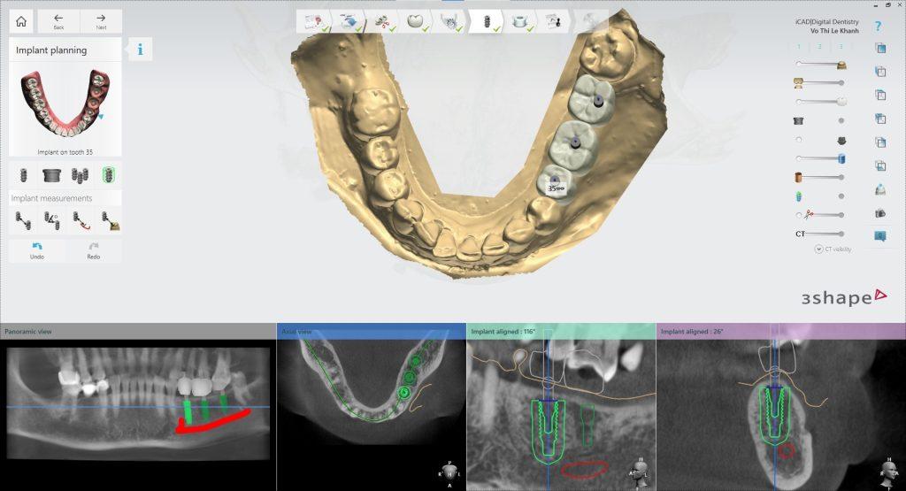 X quang Implant