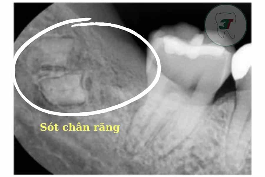 Chân răng còn sót trong xương hàm