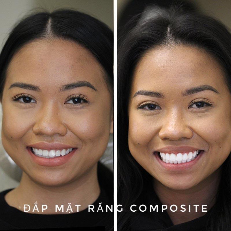 Dap Mat Rang Bang Composite