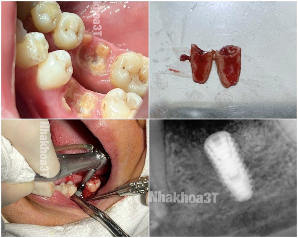 cấy ghép implant tức khi ngay khi nhổ răng