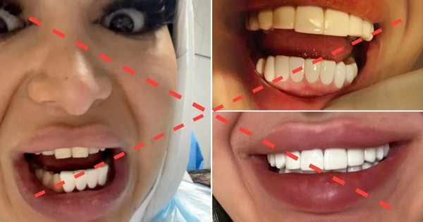 Đắp mặt răng sai kỹ thuật (phủ sứ nano spa)