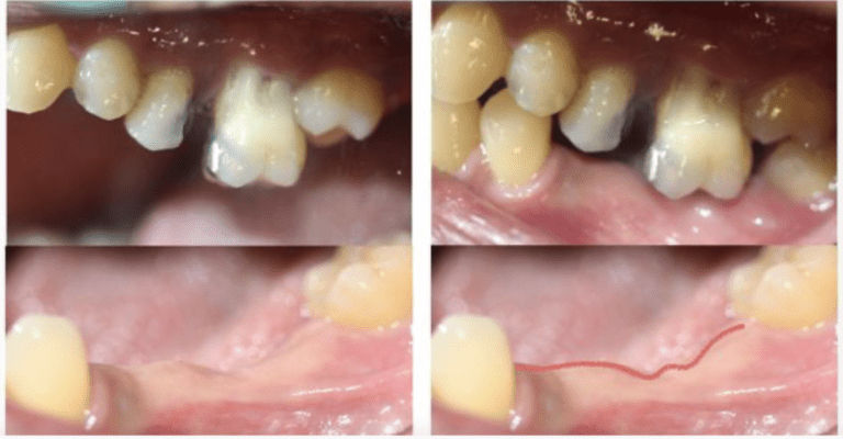 hậu quả mất răng ảnh hưởng khớp cắn