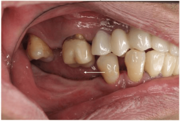 hậu quả mất răng hàm - dịch chuyển răng