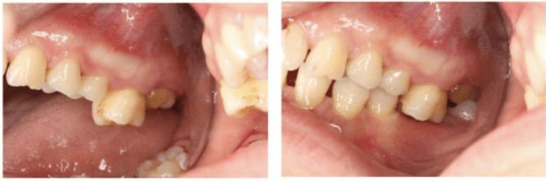 hậu quả mất răng hàm làm trồi răng đối diện