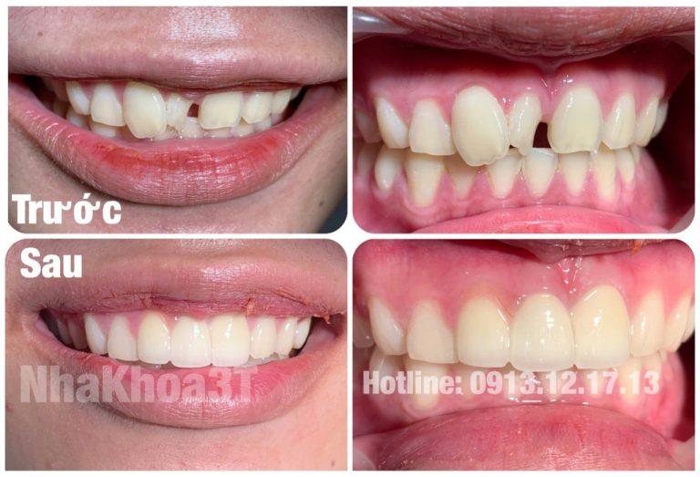 Trước và sau khi bọc sứ thẩm mỹ 4 răng cửa