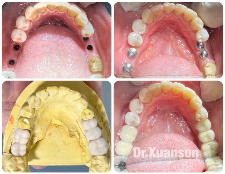 Trước và sau khi cấy Implant răng hàm