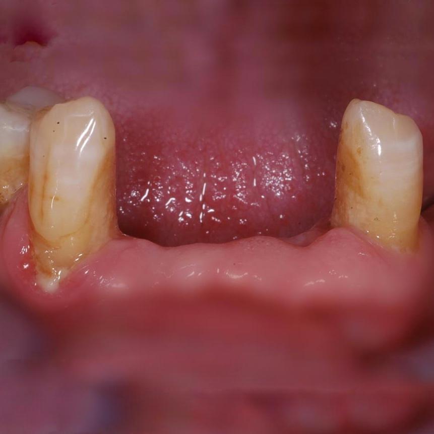 mất răng do bệnh nha chu hàm dưới