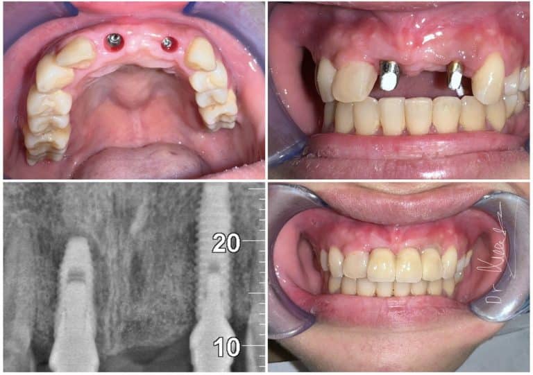 trước và sau khi cấy Implant răng cửa