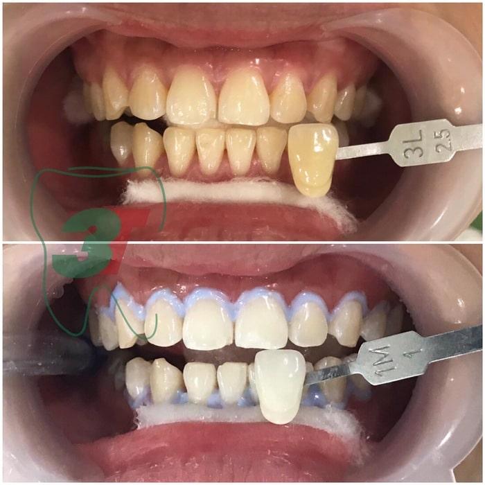 trước/sau khi tẩy trắng răng