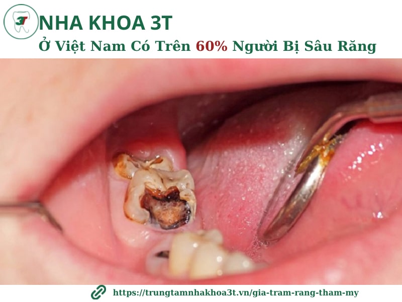 Ở Việt Nam có hơn 90% số người mắc các vấn đề về răng miệng