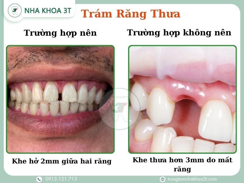 Trường hợp nên và không nên trám răng thưa