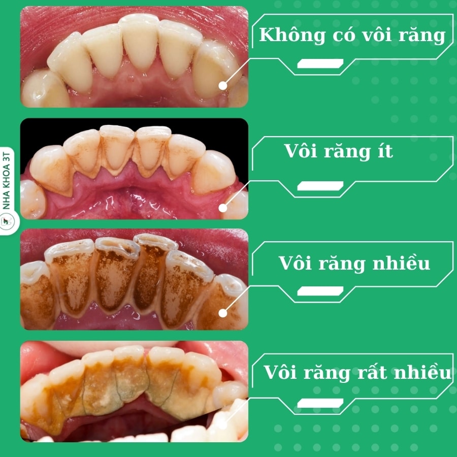 phân loại mức độ vôi răng