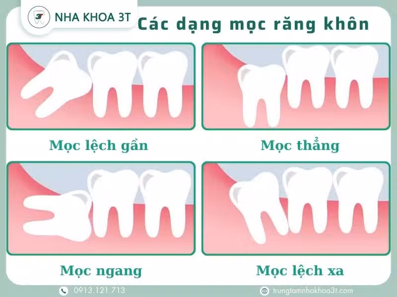 Các dạng mọc răng khôn thường gặp