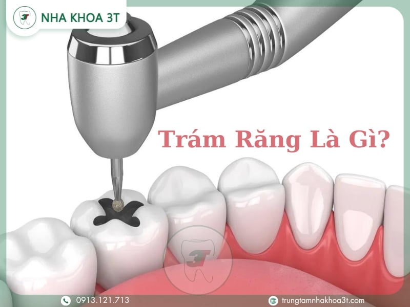 Trám răng là một quy trình nha khoa nhằm phục hồi chức năng và hình dáng của răng bị hư hại do sâu, mẻ hoặc các vấn đề khác.