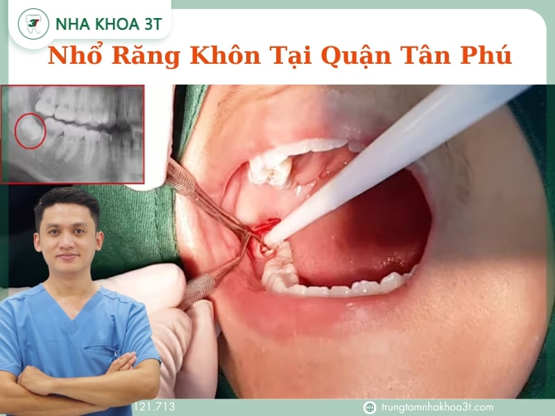 Nhổ Răng Khôn Tại Quận Tân Phú