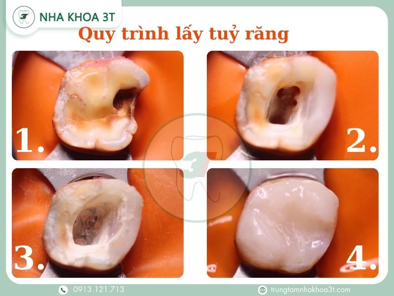 quy trình lấy tuỷ răng