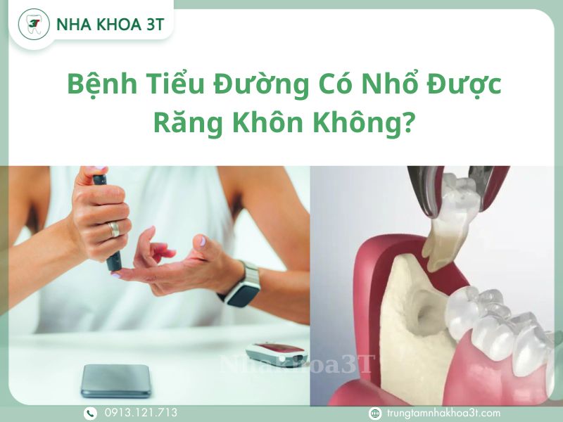 Bệnh Tiểu Đường Có Nhổ Được Răng Khôn Không?