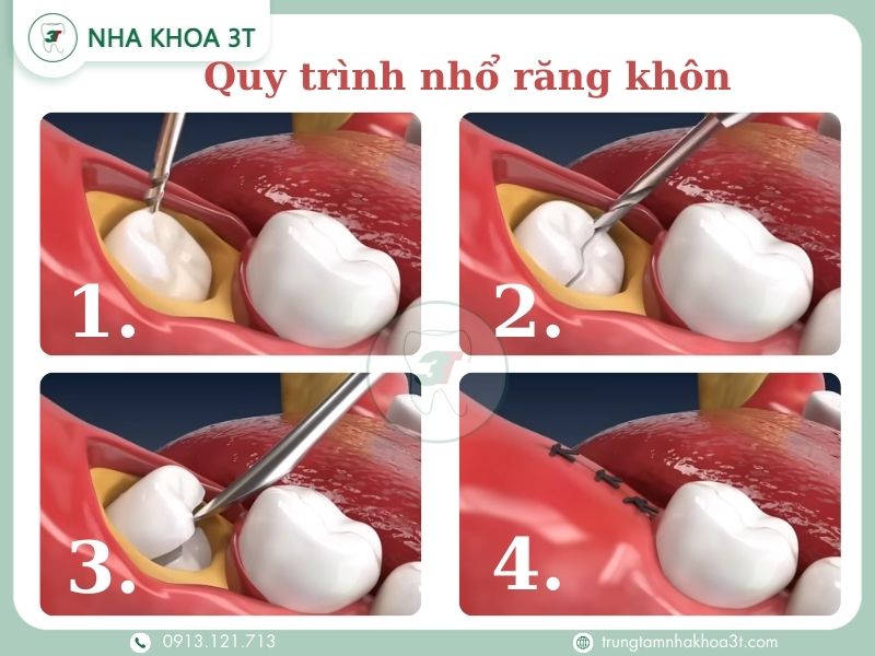 1. Bộc lộ, 2. Chia nhỏ răng khôn, 3. Nhổ từng phần, 4. Khâu lại