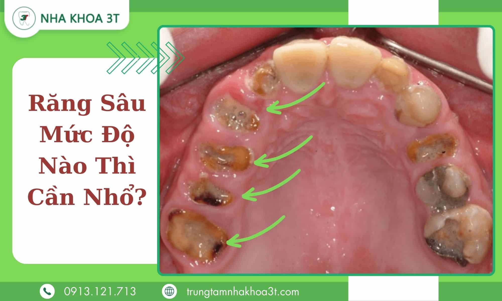 Răng bị nhiễm trùng mất dần cấu trúc chỉ còn chân phải nhổ bỏ