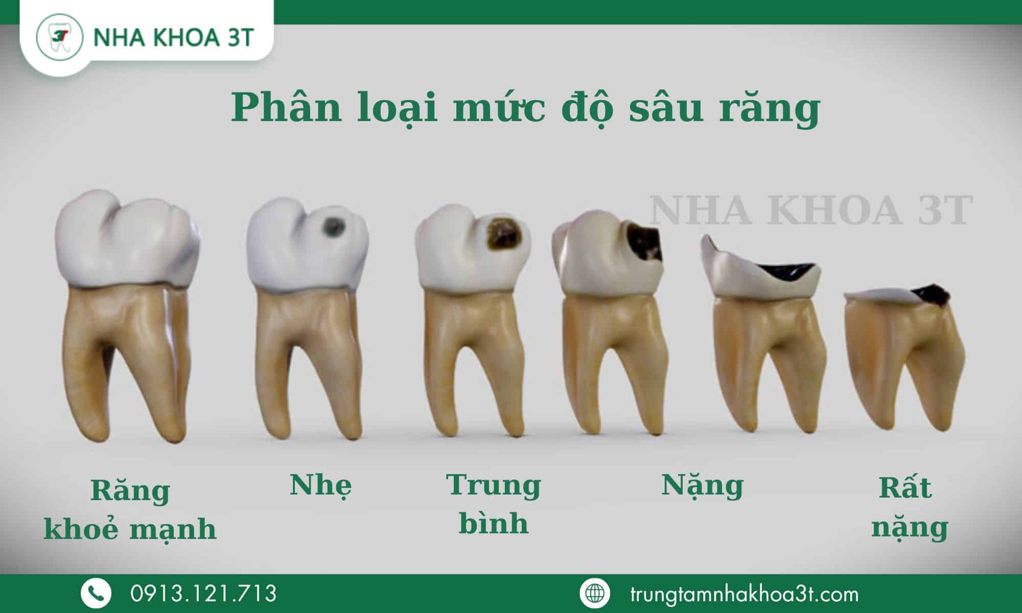 Phân loại mức độ sâu răng