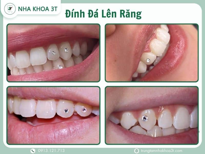 Đính đá lên răng